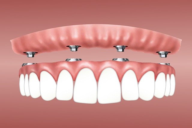 вживление зубных имплантов