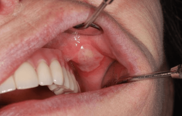 Как лечить белые язвы в полости рта, чем мазать, полоскать и как от них  избавиться: причины, почему появляются язвочки, быстрое лечение слизистой,  фото