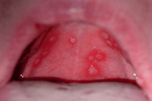 Как лечить белые язвы в полости рта, чем мазать, полоскать и как от них  избавиться: причины, почему появляются язвочки, быстрое лечение слизистой,  фото