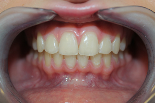 какие виды отбеливания зубов бывают
