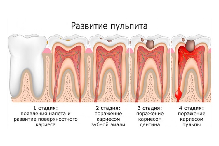 пульпит при беременности 1 триместр