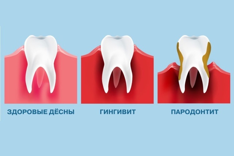 гингивит у ребенка