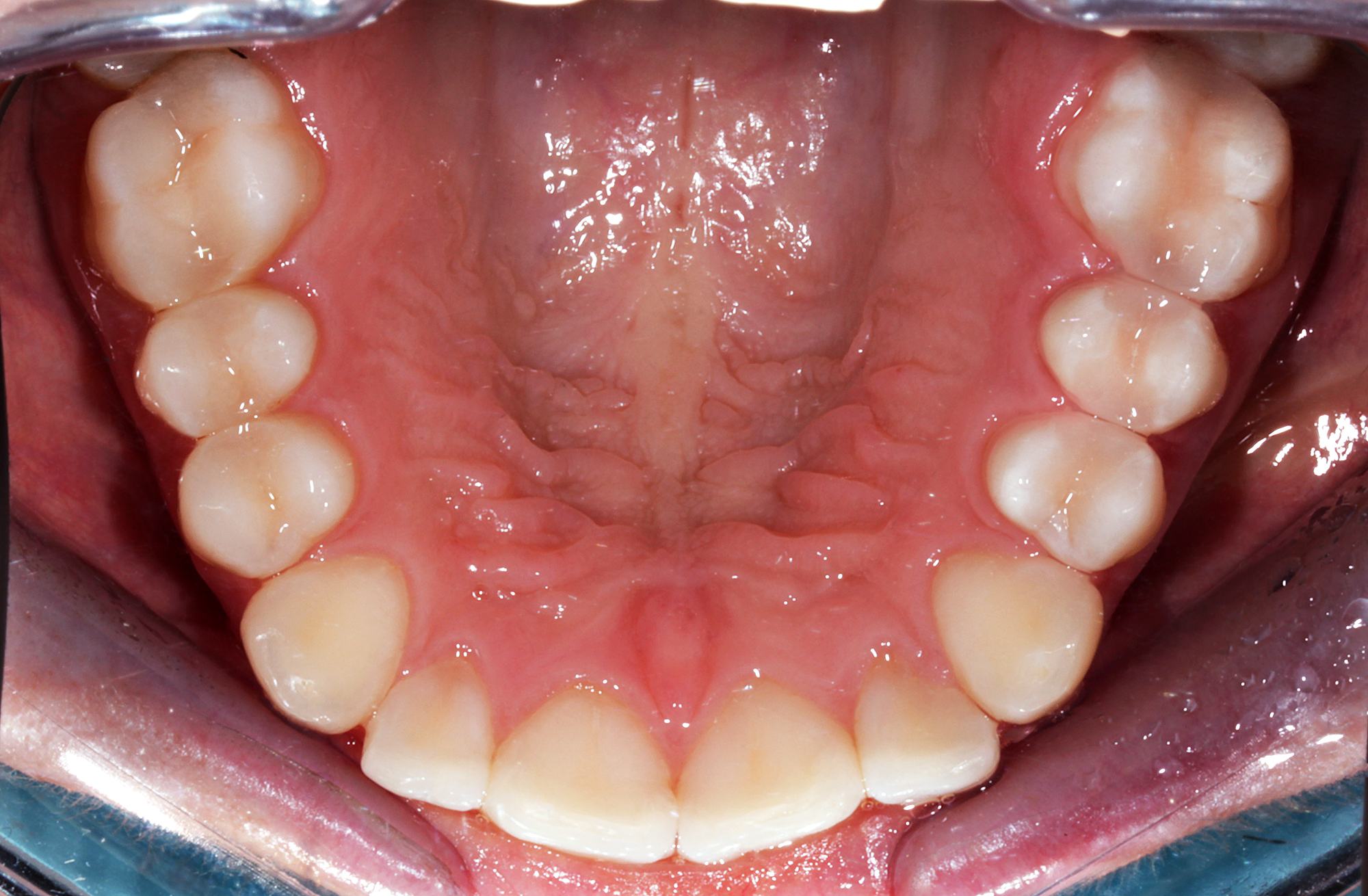 Основные причины появления зубного камня