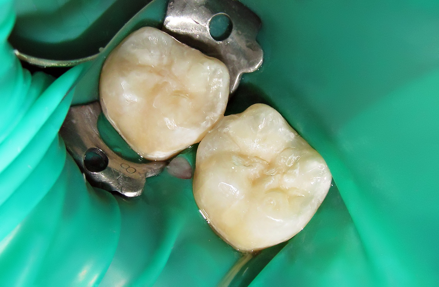 Десна отходит от зуба: каковы причины и лечение