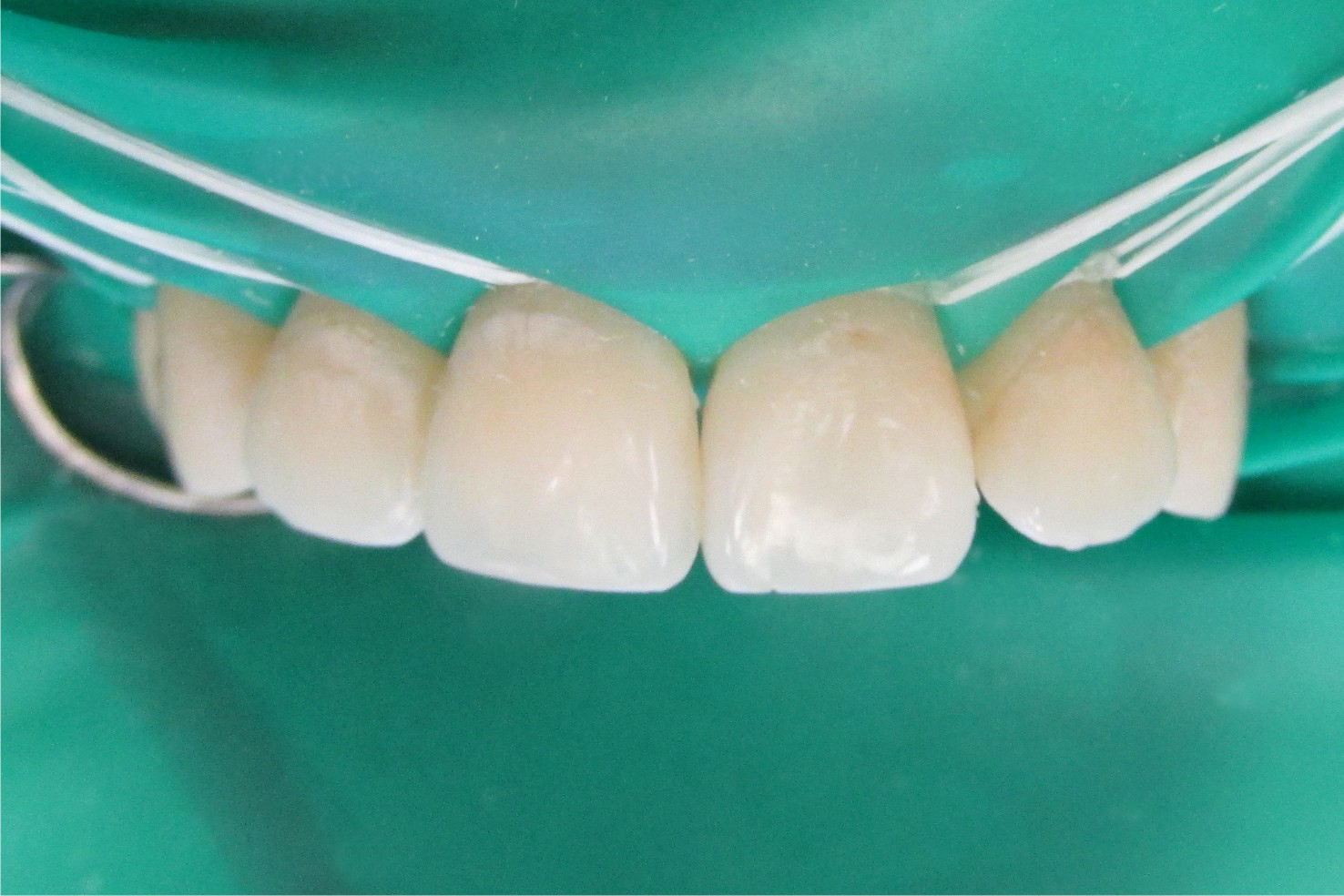 Как уберечь зубы от гиперестезии?