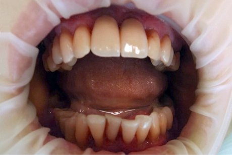 Какие основные причины появления зубного налета и зубного камня?