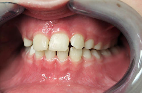 Кривые нижние зубы у ребенка – лечение