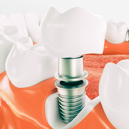 Средняя цена лечения зубов в воронеже thumbnail