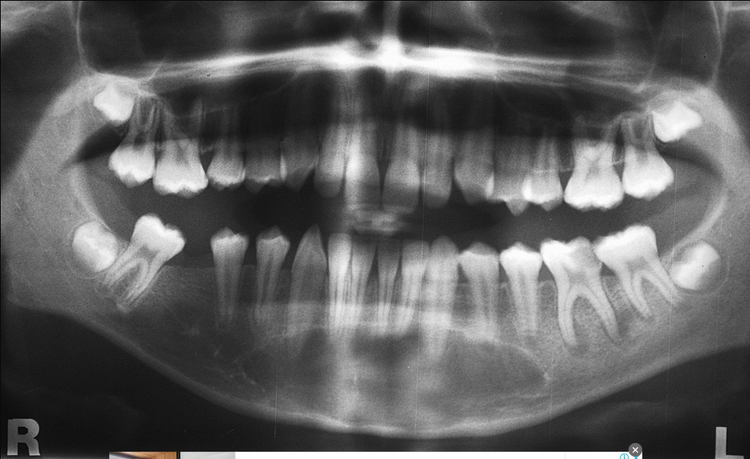 Нагноение десны зуба