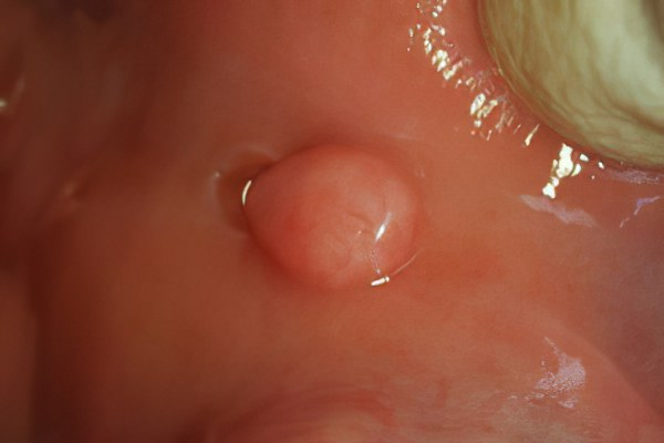 фиброма во рту