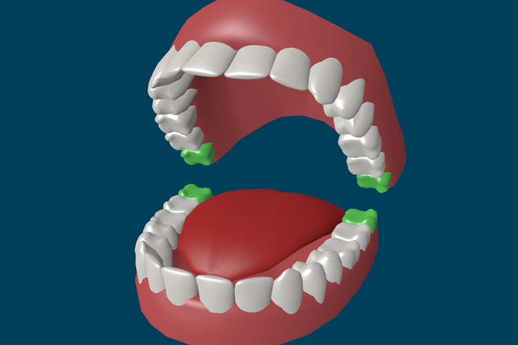 Как исправить кривые зубы