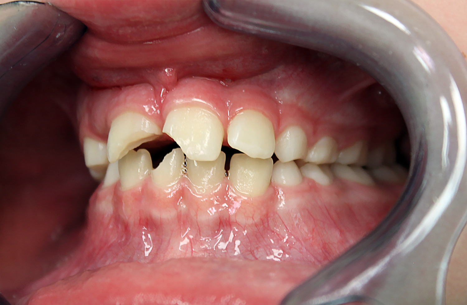 Порядок прорезывания зубов