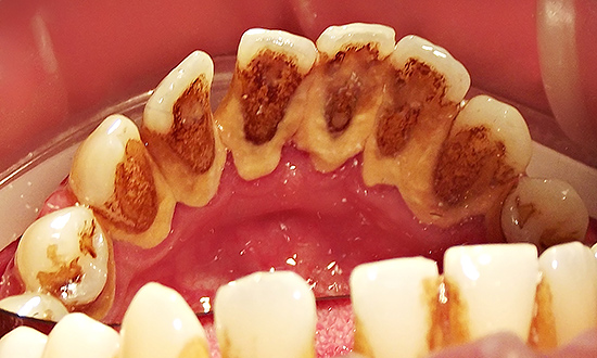 Почему зубы болят от холодного и горячего? Как это вылечить?