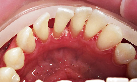 Удаление нерва зуба